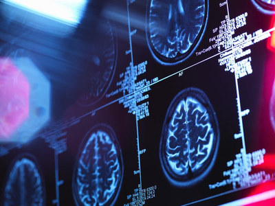 3 cases of rare brain disease reported in Oregon