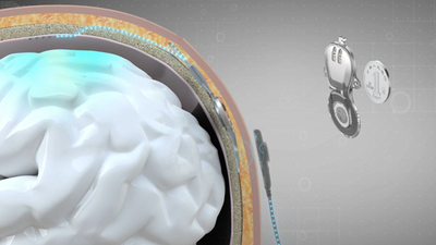 China beats Elon Musk’s Neuralink to the world’s first commercial brain-computer interface implant